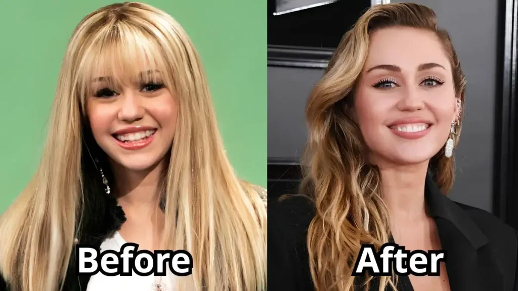 miley cyrus teeth before and after